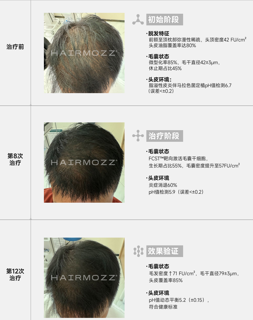 HAIRMOZZ生发案例
